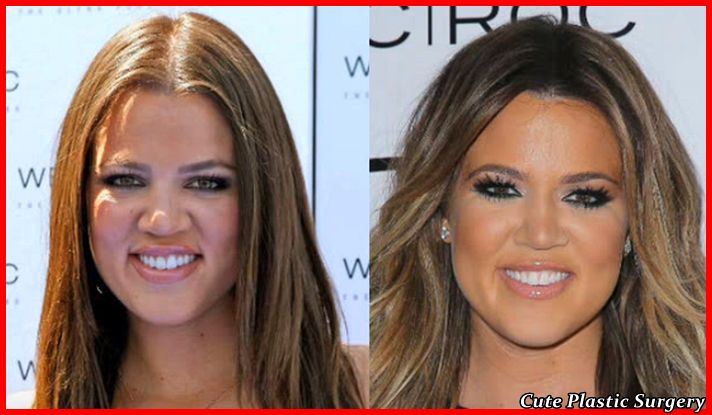 Khloe Kardashian Plastic Surgery Pictures - Celebrities Plastic Surgery