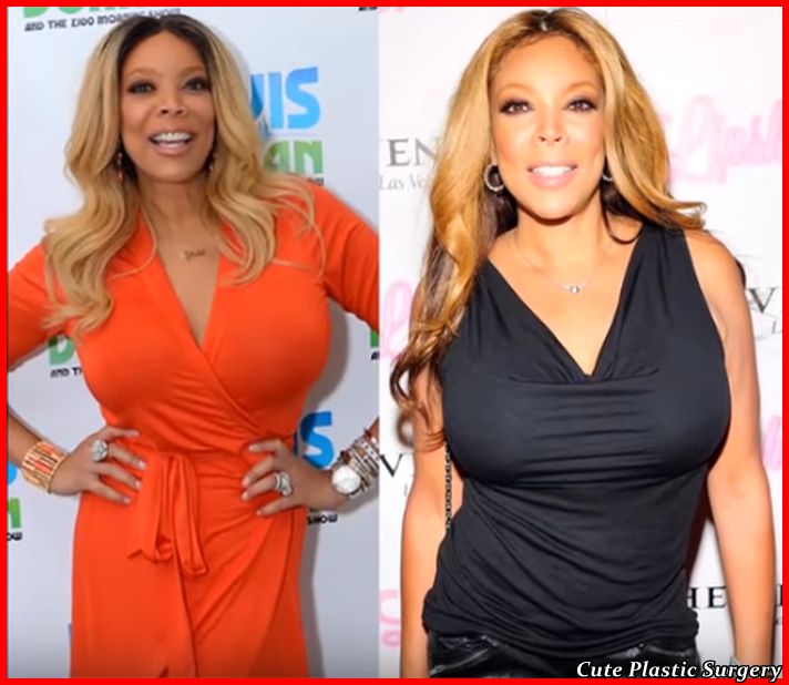 Wendy Williams Plastic Surgery Celebrities Plastic Surgery