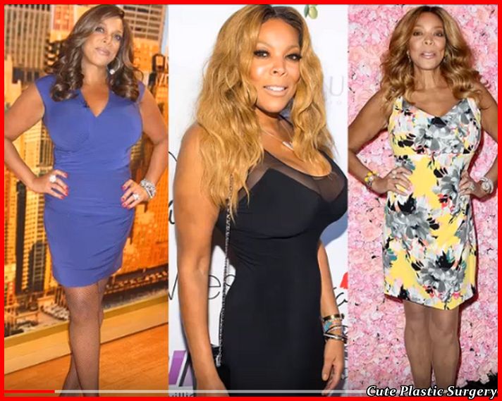 Wendy Williams Plastic Surgery Celebrities Plastic Surgery