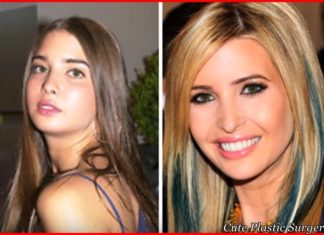 Ivanka Trump Plastic Surgery before and after 2