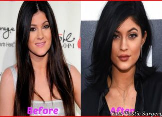 Kylie-Jenner-Plastic-Surgery-Before-and-After
