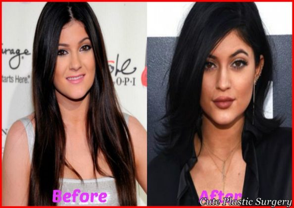Kylie-Jenner-Plastic-Surgery-Before-and-After
