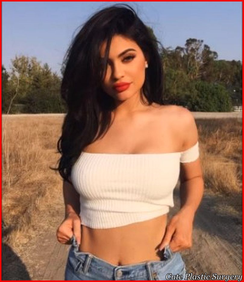 Kylie Jenner Plastic Surgery - before and after picture