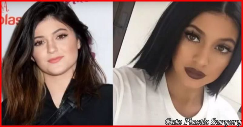 kylie jenner Before and After Plastic Surgery 1