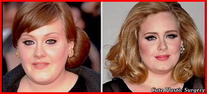 Adele nose job before and after nice plastic
