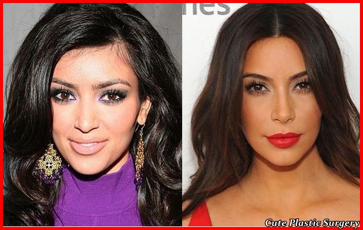 Kim kardashian surgery | Kim kardashian surgery 