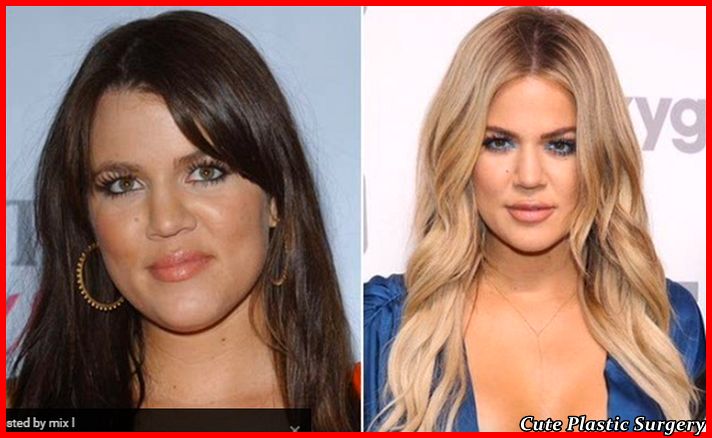 Khloe Kardashian Plastic Surgery Pictures - Celebrities Plastic Surgery