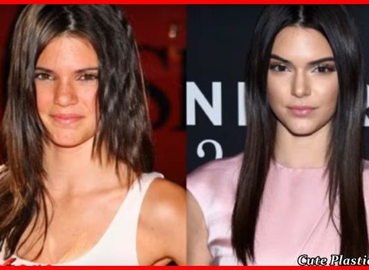 Kеndаll Jenner Lip Job