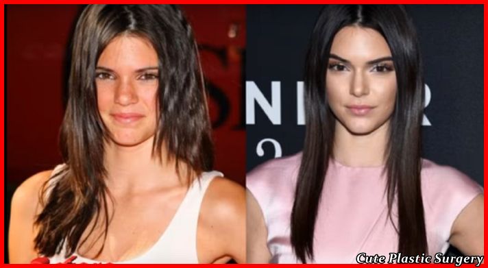 Kеndаll Jenner Lip Job