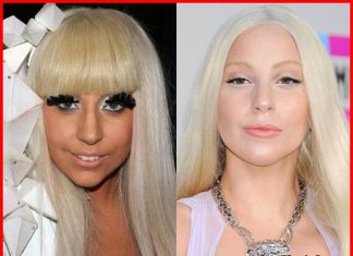 Lady Gaga plastis surgery