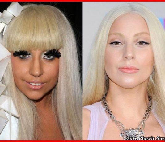 Lady Gaga plastis surgery