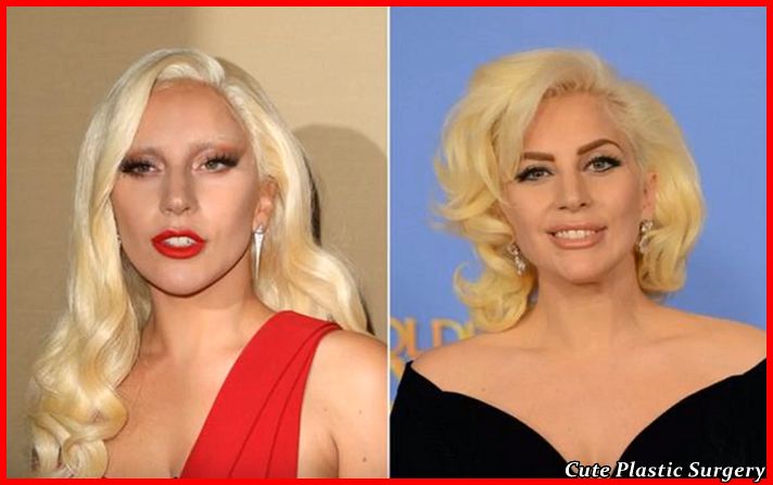 Lady Gaga Facelift