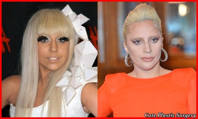 Lady Gaga Plastic Surgery - Before and After - Celebrities Plastic Surgery