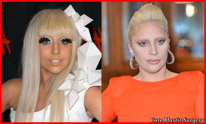 Lady Gaga Lip Injection