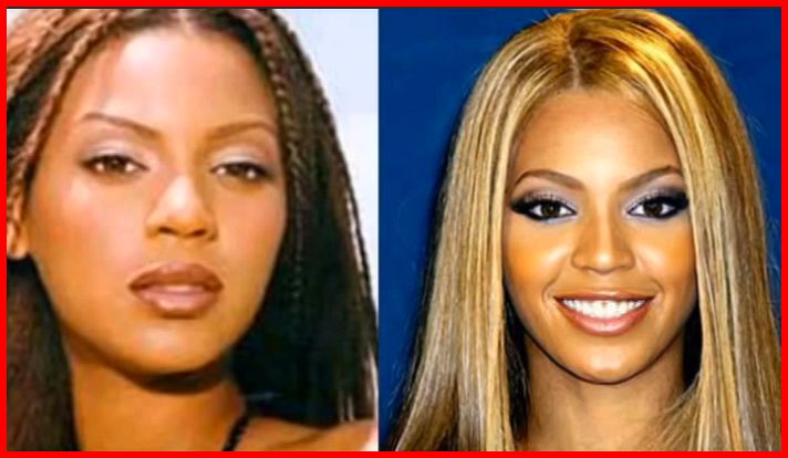 Beyonce Nose Job before and after