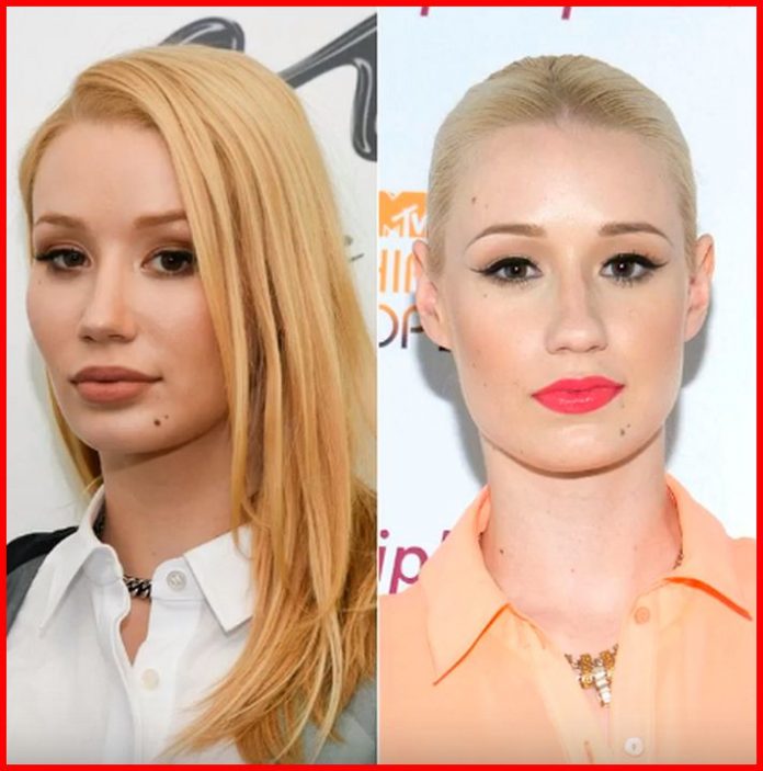 Iggy Azalea Plastic Surgery Pictures - Celebrities Plastic Surgery