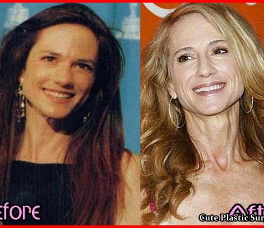 Holly Hunter Plastic Surgery