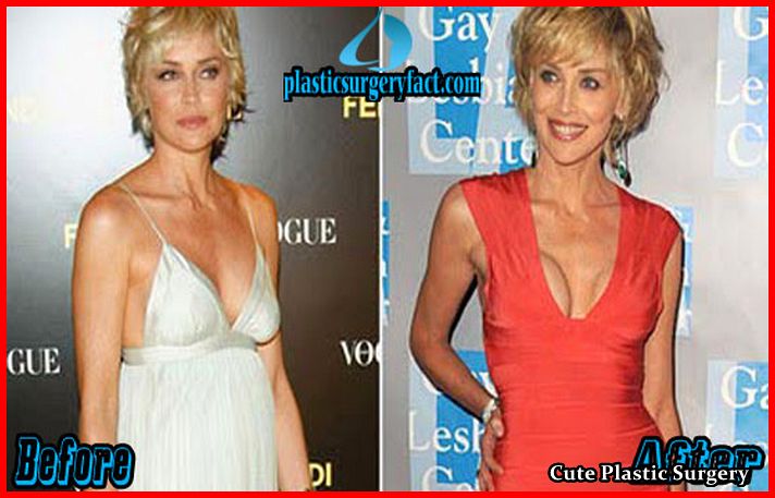 Sharon Stone Breast Implants