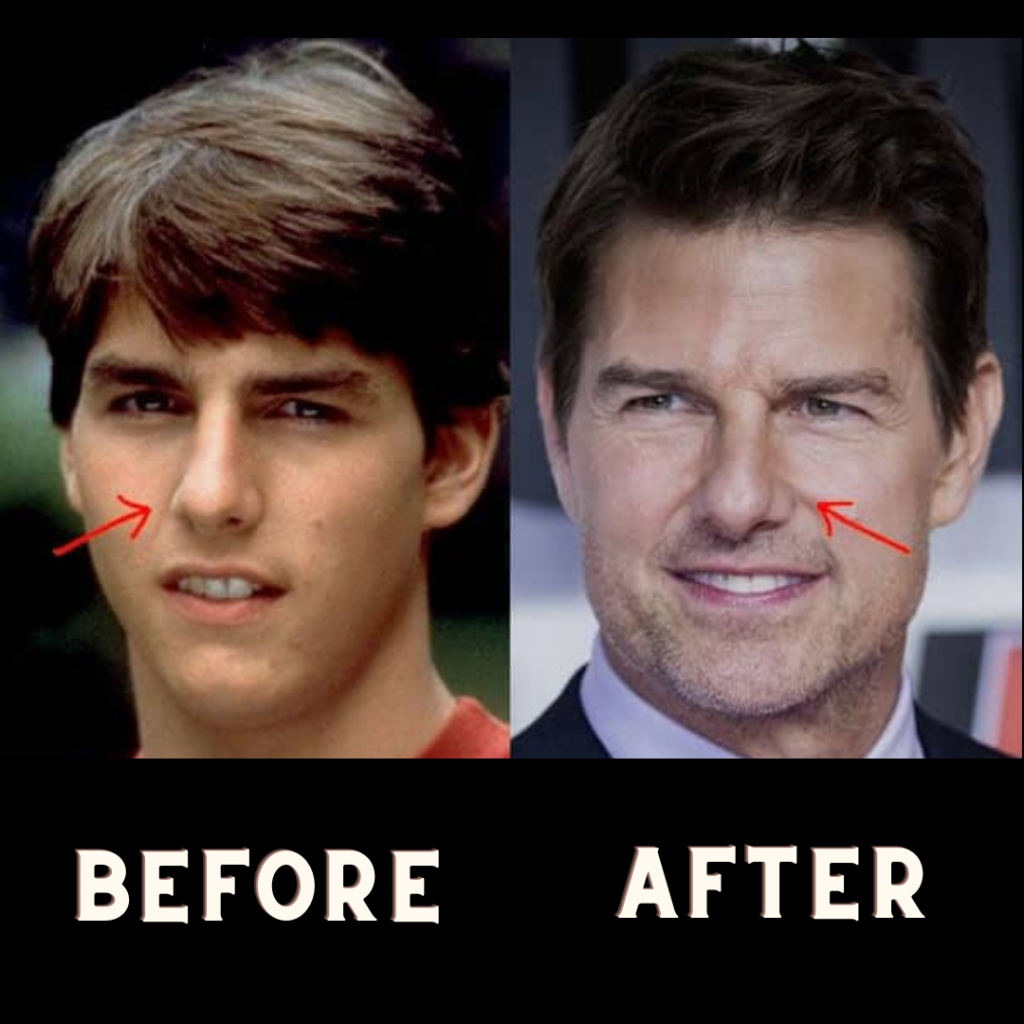 Tom Cruise Surgeries